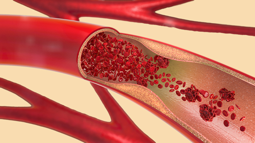 Tromboza Venoasa Profunda trombembolism Pulmonar Reginamaria ro
